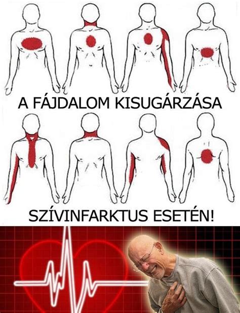 A fájdalom kisugárzása az isiász esetén