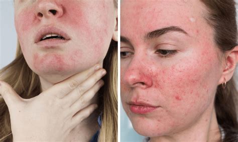 Rosacea tünetei