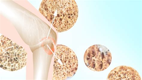 Csontritkulás ábrája