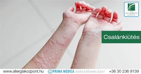 Diszulfirám-szerű reakció tünetei