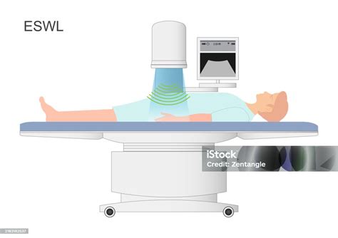Ultrahangos kőzúzás (ESWL) folyamata