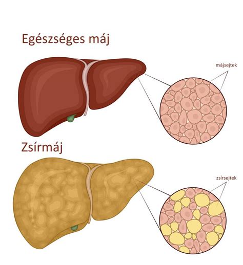 Infografika a zsírmáj kialakulásáról