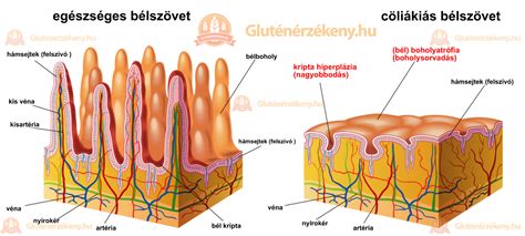 Vékonybél bolyhok károsodása cöliákiában