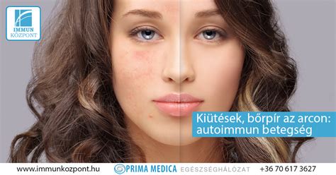 alkoholizmus tünetei az arcon