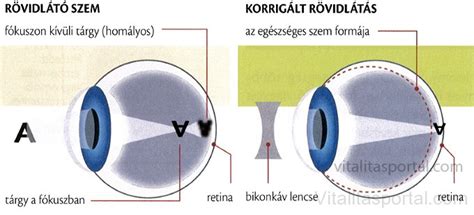 Rövidlátó szem és normál szem összehasonlítása