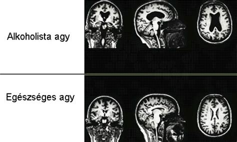 Az agy idegsejtjei és az alkohol hatása