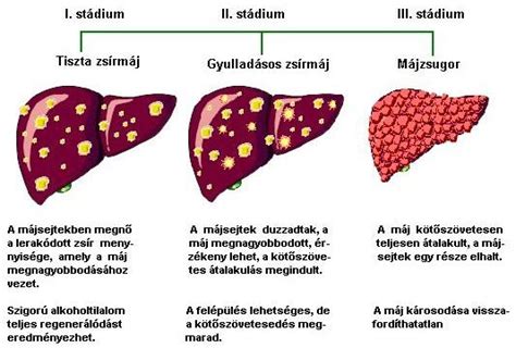A májzsugor és az alkohol kapcsolata