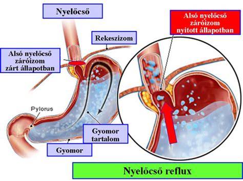 nyelőcső reflux vizualizációs diagram