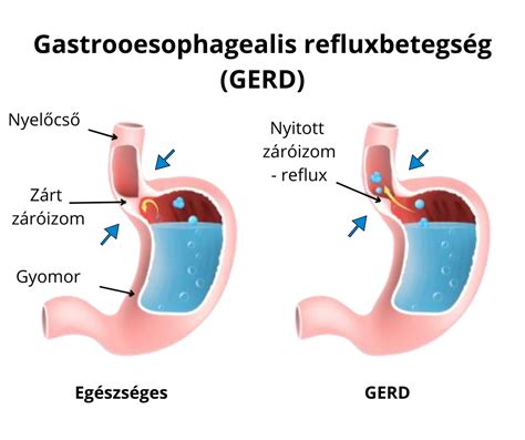 nyelőcső-refluxbetegség vizuális összefüggései