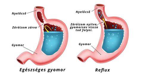 Reflux és gyomor-nyelőcső kapcsolat vizualizáció
