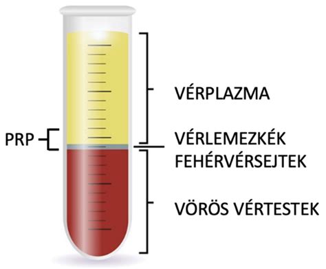 Vérplazma infúzió