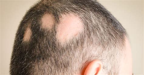 Egy infografika, amely bemutatja az alopecia areata különböző típusait és azok jellegzetes megjelenését.