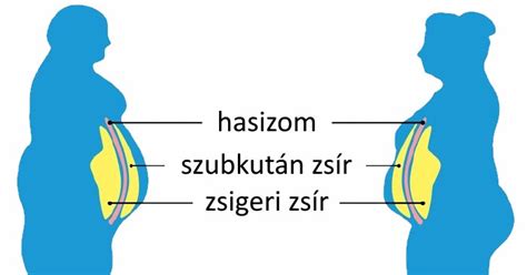 Infografika a zsigeri zsír és a bőr alatti zsír különbségeiről